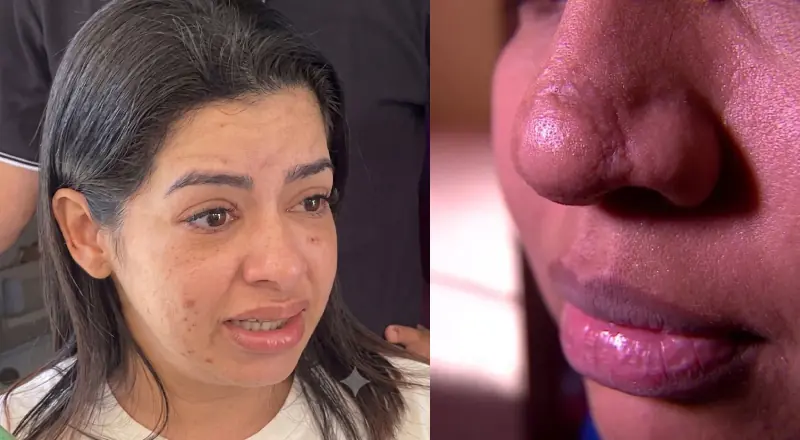 Falsa biomédica é presa de novo em Manaus e minimiza necrose em cliente: “Ela denuncia porque o resultado não agrada”; vídeo
