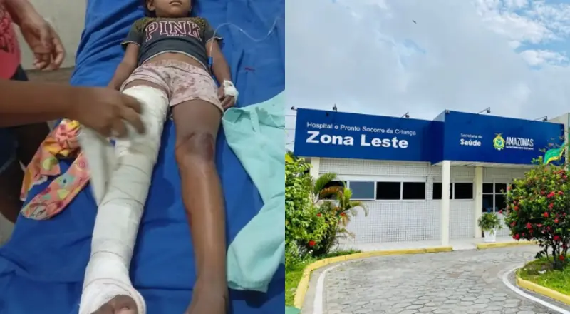 Mais uma vítima no trânsito: Menina de 8 anos é transferida para hospital de Manaus às pressas com fraturas